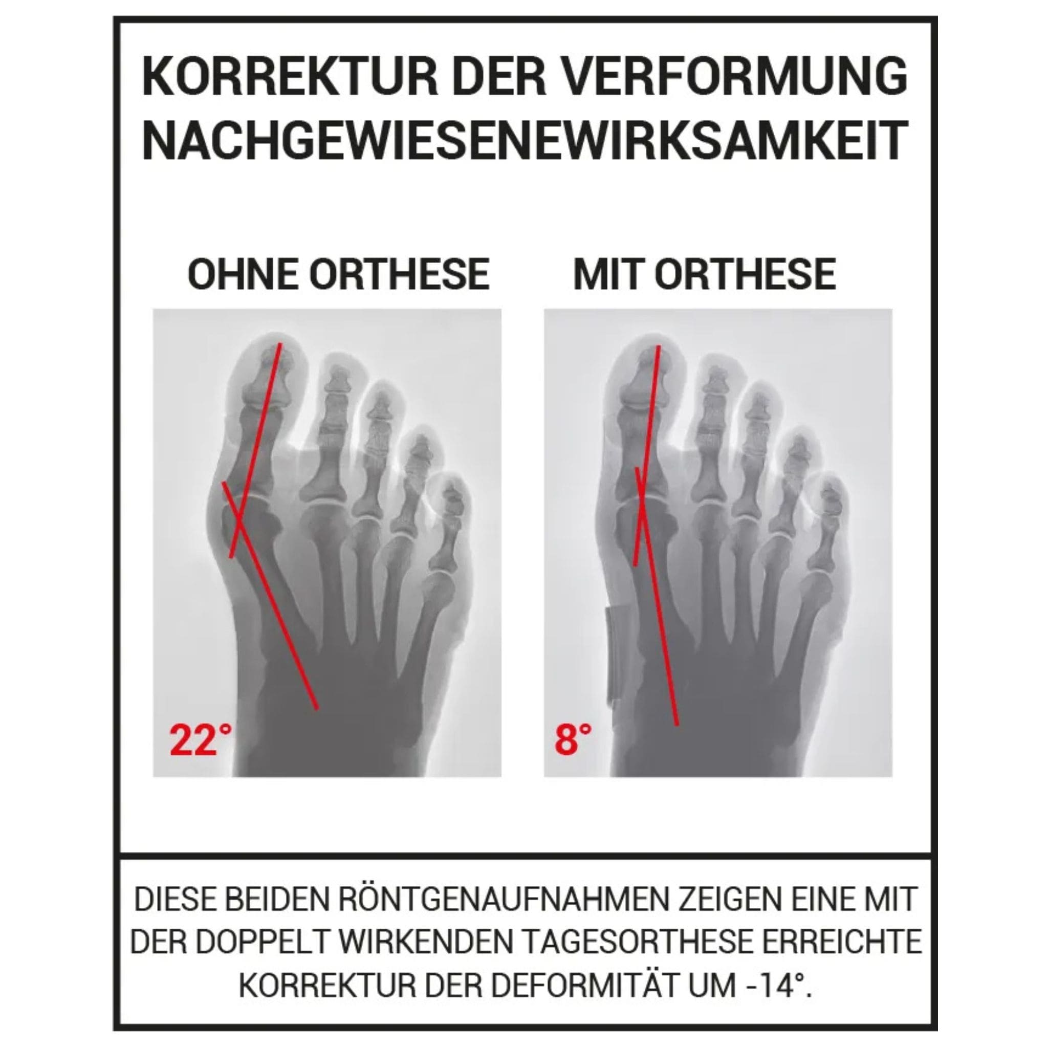 Hallux Valgus Erklärung