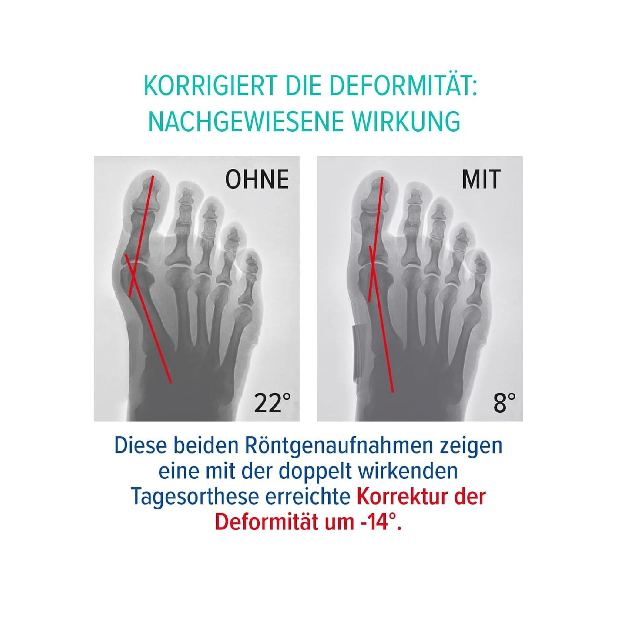 Hallux Valgus Tagesbandage Erklärung