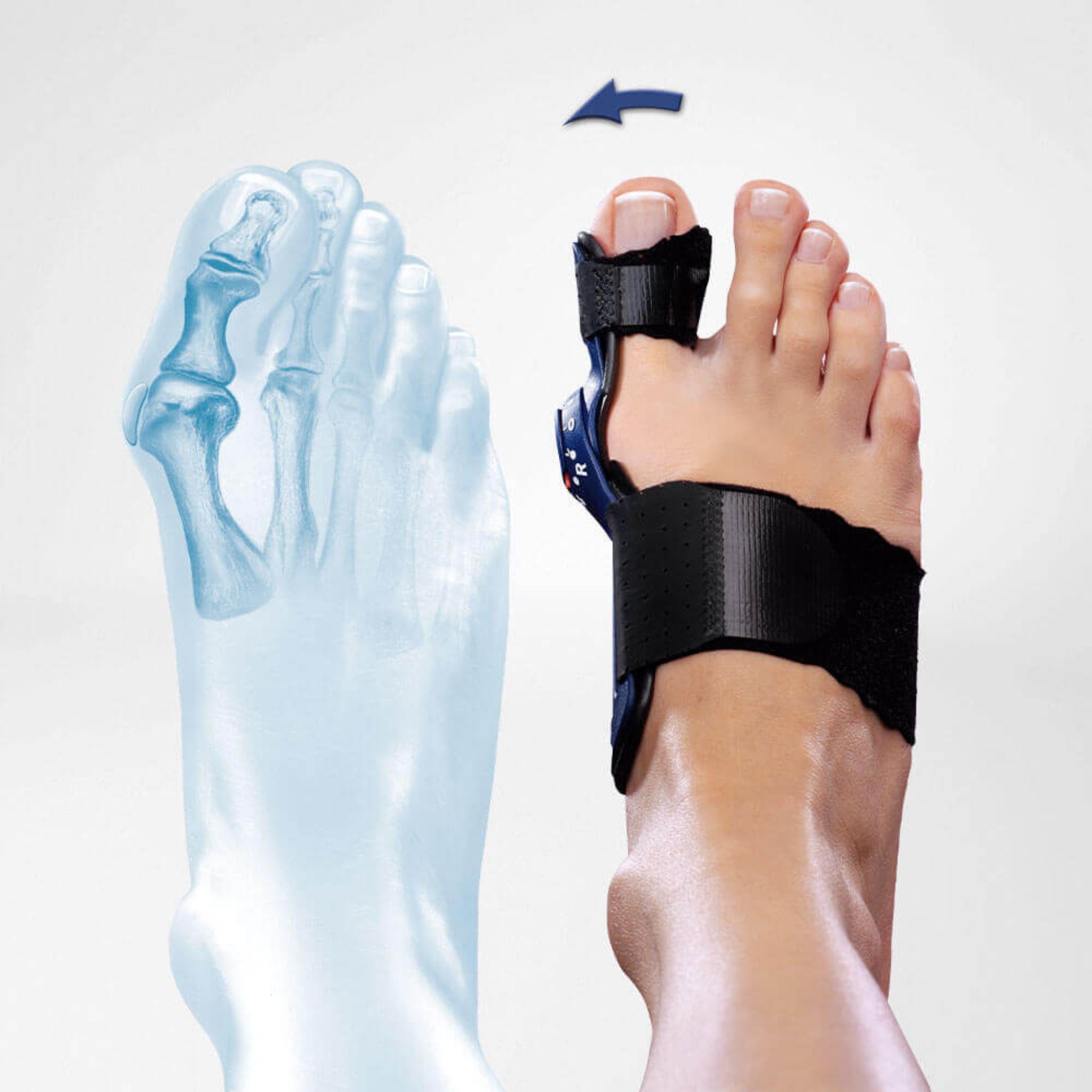 Hochwertige Hallux Valgus Orthese