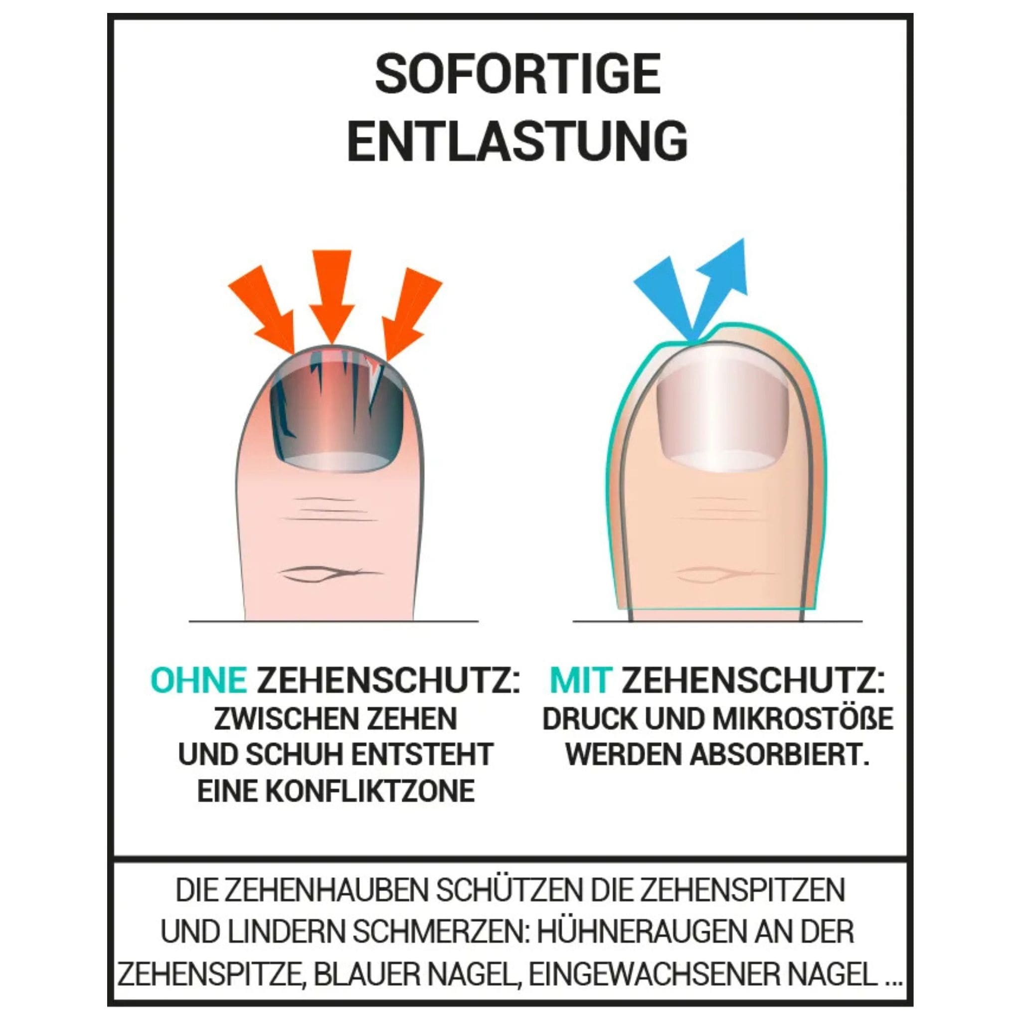 Zehenschutz gegen blaue Zehennägel