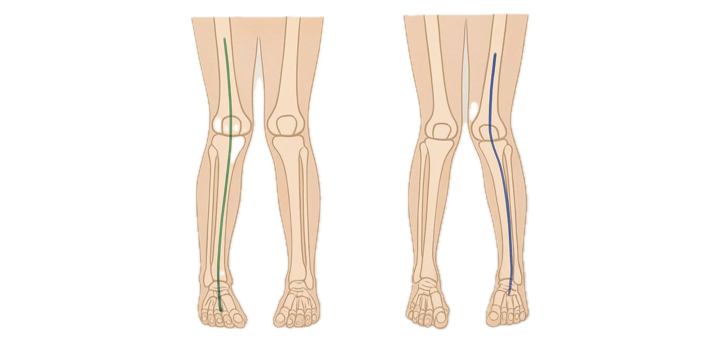 Artikel zur Valgusgonarthrose