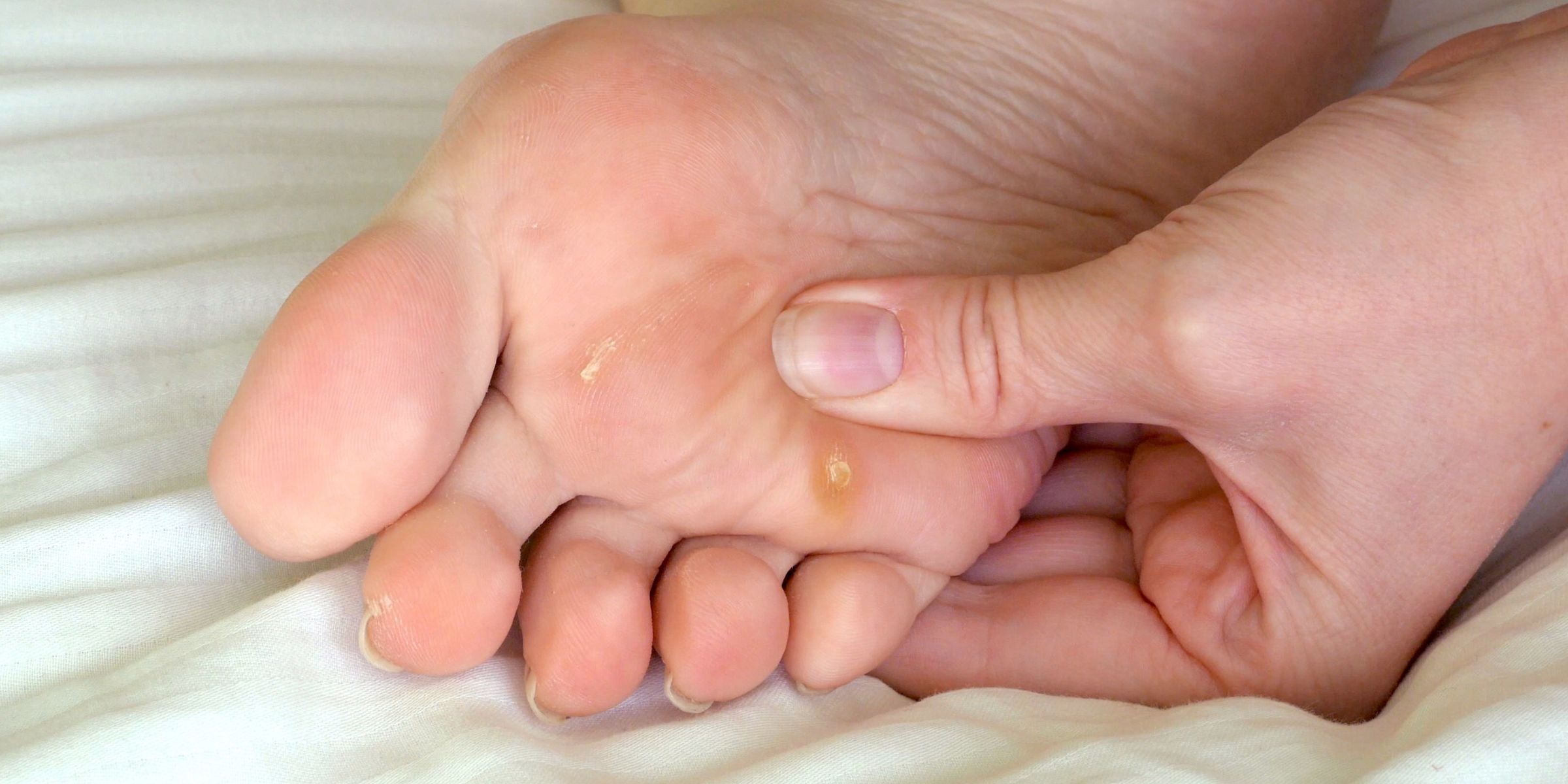 Hühneraugen entfernen