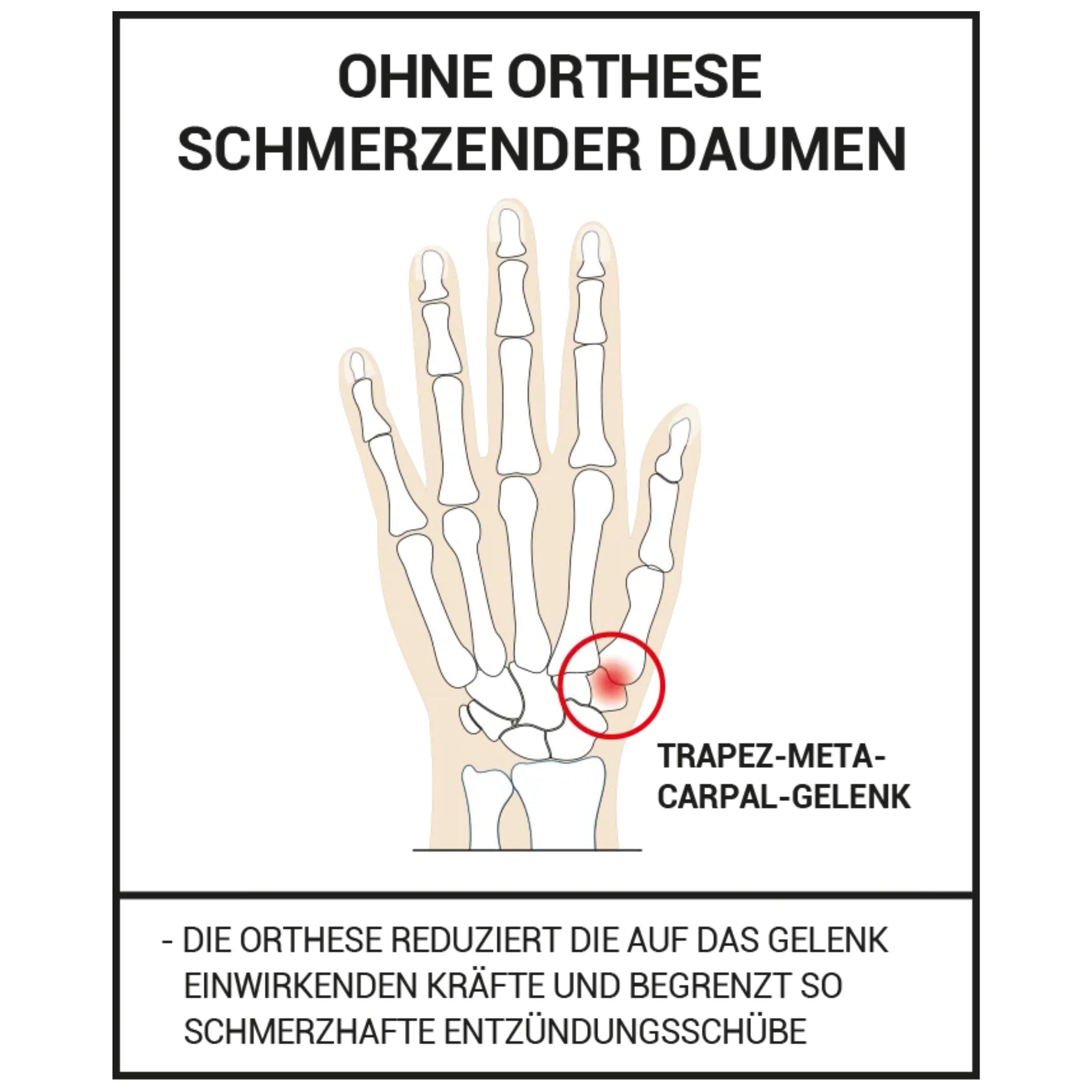 Daumenstütze zur Vorbeugung und Linderung von Arthroseschmerzen im Daumensattelgelenk