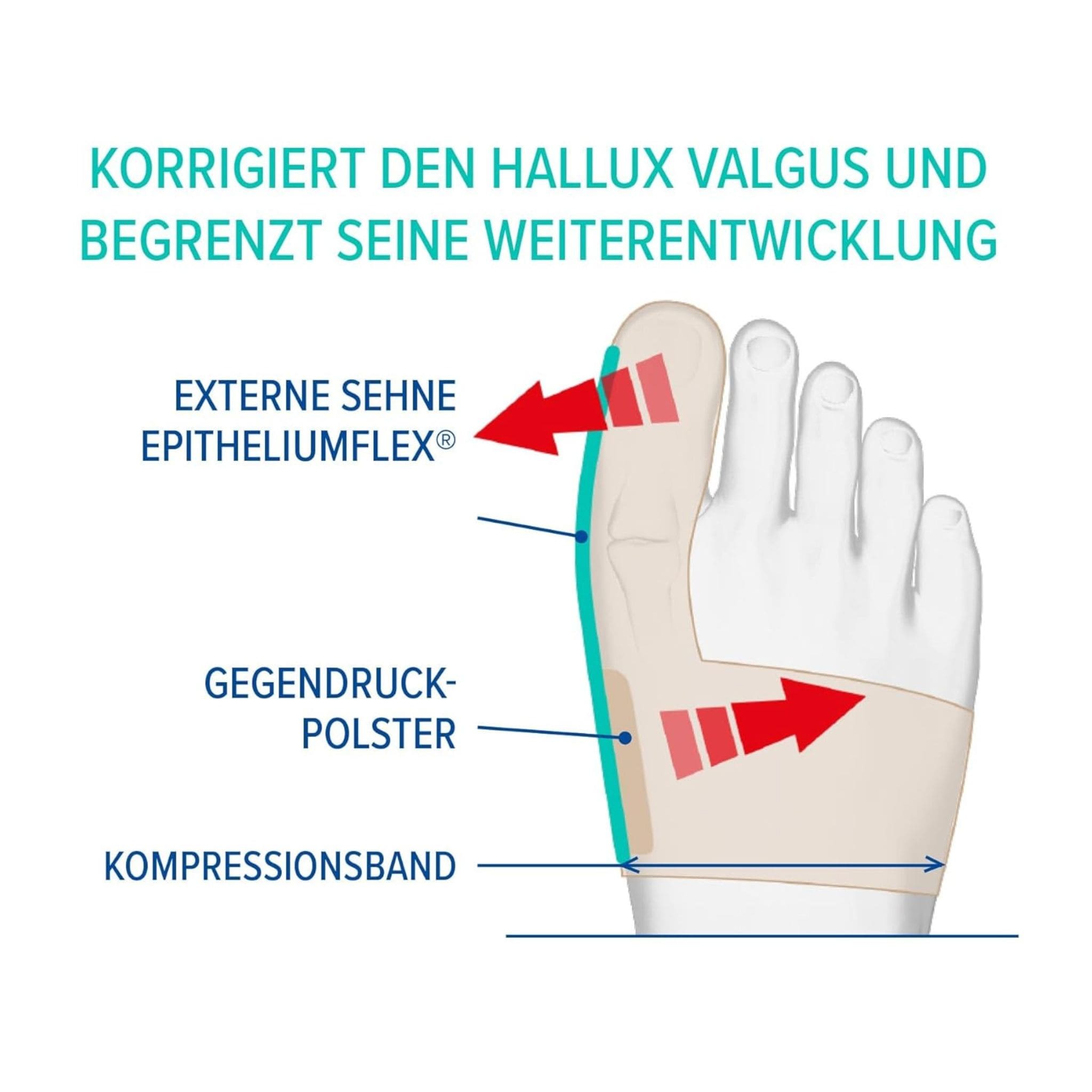 Wirkweise der Epitact Hallux Valgus Tagesorthese